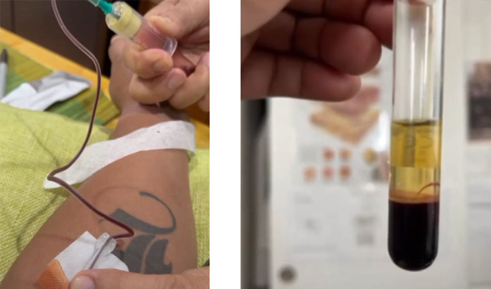 Knee PRP treatment